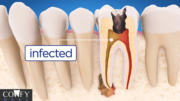 چرا برای عصب کشی به متخصص درمان ریشه مراجعه کنیم